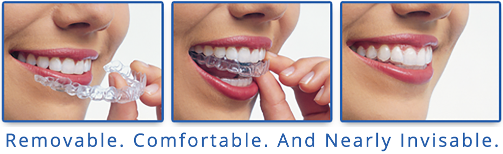 Invisalign Clear Braces For Adults, Dr. Aly Kanani