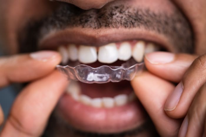 https://www.dralykanani.com/files/langley-orthodontist-invisalign-vs-braces.jpeg